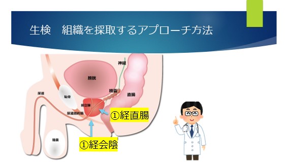 膀胱生検が行われる理由