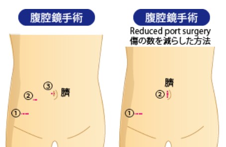 尿膜管膿瘍 のうよう 臍炎 さいえん おへそから膿がでる おへそが痛い 佐々木クリニック泌尿器科 芝大門 浜松町 港区 東京都